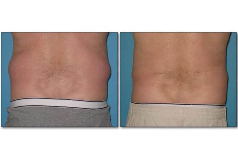 Liposuction Napa Solano Plastic Surgery