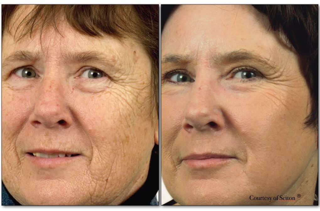 Sciton® Erbium Laser Skin Resurfacing Napa Solano Plastic Surgery And Medspa