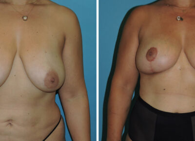 Breast Procedure Patient 9