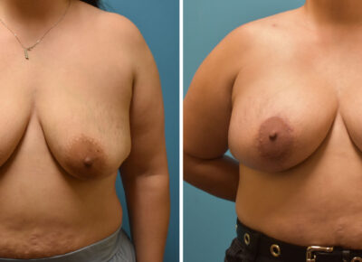 Breast Procedure Patient 10