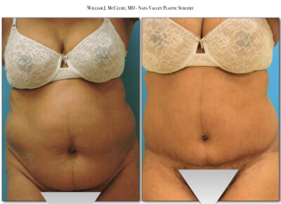 Abdominoplasty – Dr. McClure 6