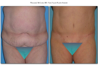 Abdominoplasty – Dr. McClure 8