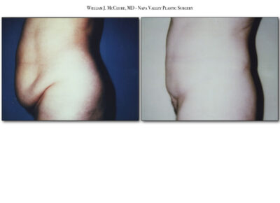 Abdominoplasty – Dr. McClure 16