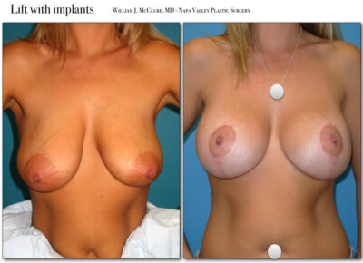 Breast Reduction – Dr. McClure 12