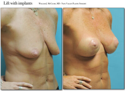 Breast Reduction – Dr. McClure 8