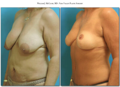 Breast Reduction – Dr. McClure 7