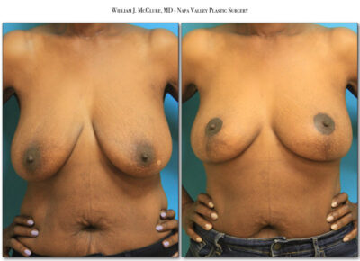 Breast Reduction – Dr. McClure 11