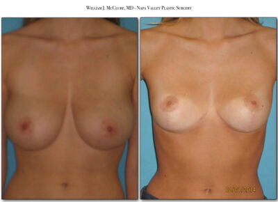 Breast Reduction – Dr. McClure 10