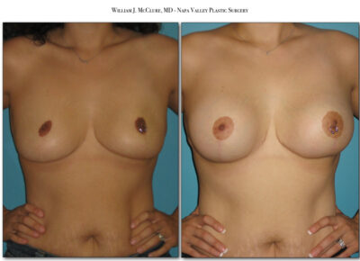 Breast Lift with Implants – Dr. McClure 3