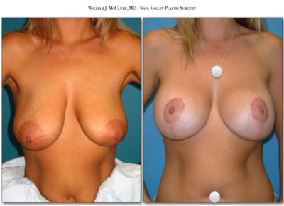 Breast Lift with Implants – Dr. McClure 4