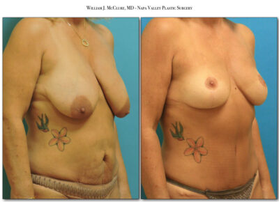 Breast Reduction – Dr. McClure 2