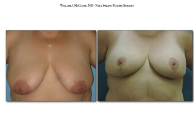 Breast Lift with Implants – Dr. McClure 6