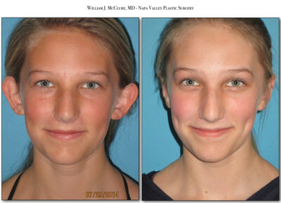 Otoplasty – Dr. McClure 1