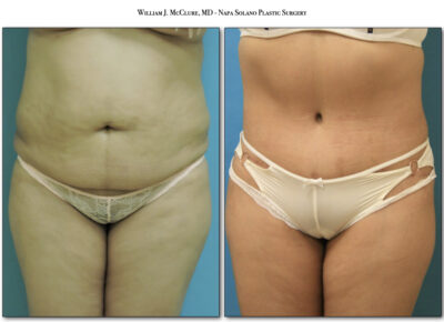 Abdominoplasty – Dr. McClure 4