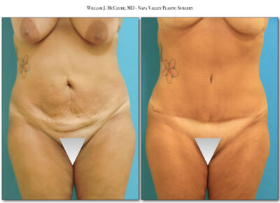 Abdominoplasty – Dr. McClure 3