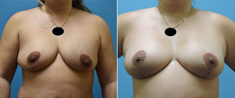 breast lift patient