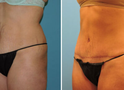 Abdominoplasty Dr Zeiderman 3