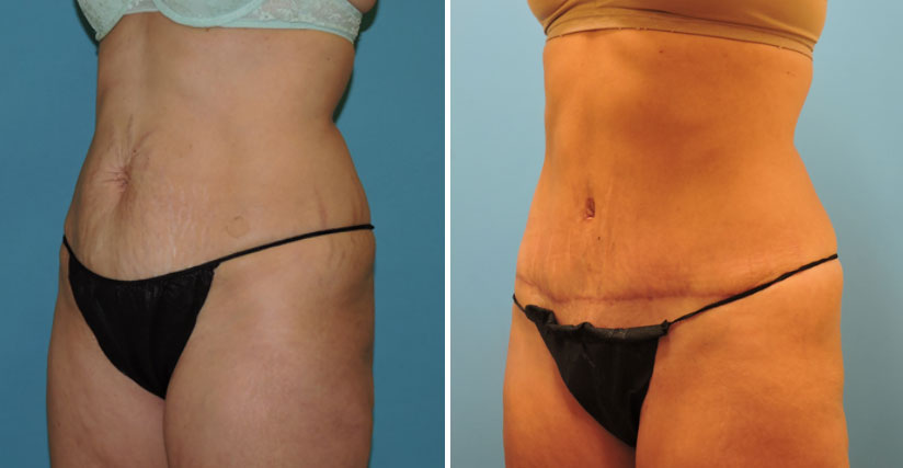 tummy tuck patient