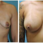 Thumbnail of http://Breast%20Augmentation%20Before%20&%20After