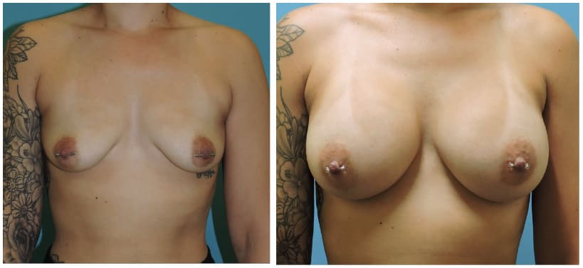 Breast Augmentation Before & After