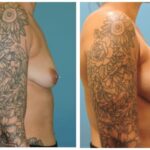 Thumbnail of http://Breast%20Augmentation%20Before%20&%20After