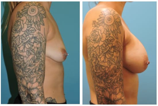 Breast Augmentation Before & After