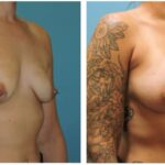 Thumbnail of http://Breast%20Augmentation%20Before%20&%20After