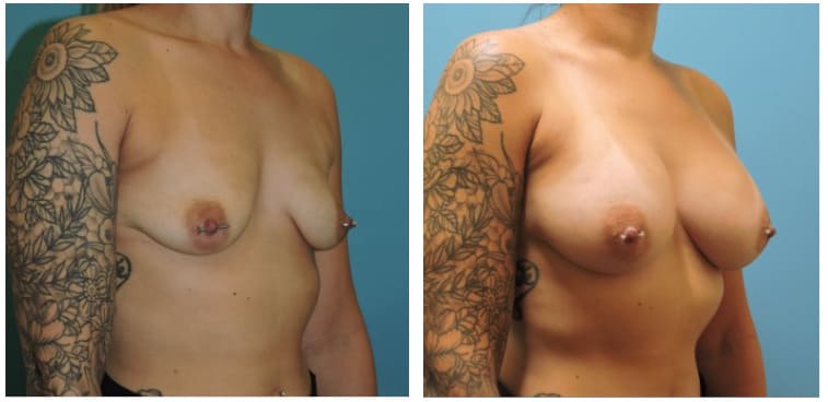 Breast Augmentation Before & After