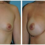 Thumbnail of http://Breast%20Augmentation%20Before%20&%20After