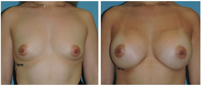 Breast Augmentation Before & After