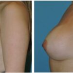 Thumbnail of http://Breast%20Augmentation%20Before%20&%20After