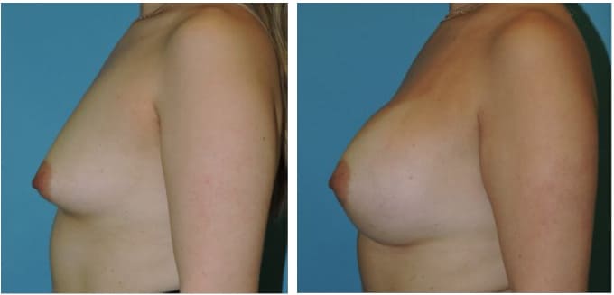 Breast Augmentation Before & After