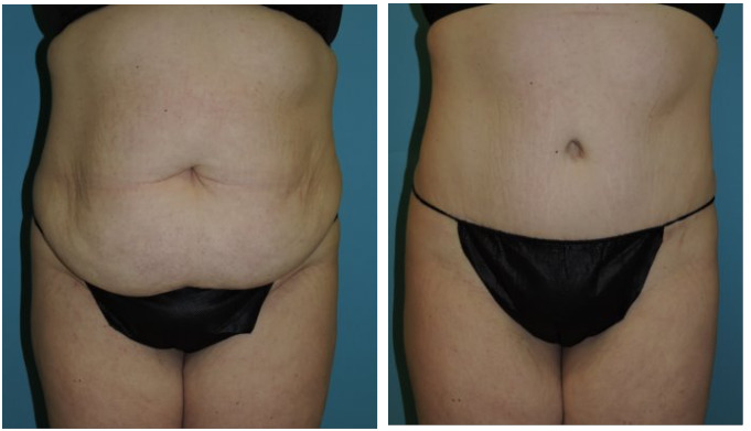 Abdominoplasty Before & After