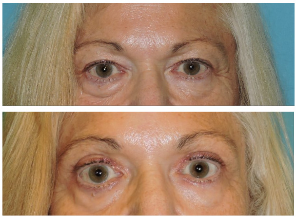 Blepharoplasty Before & After