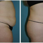 Thumbnail of http://Abdominoplasty%20Before%20&%20After