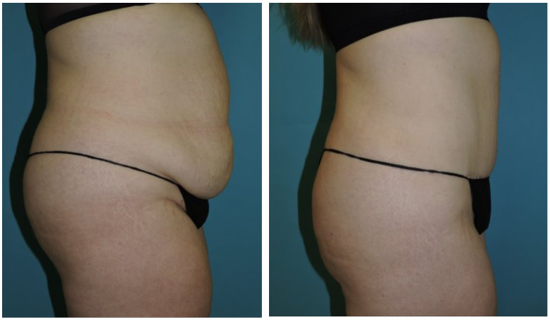 Abdominoplasty Before & After