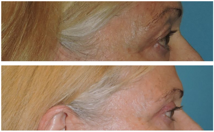 Blepharoplasty Before & After