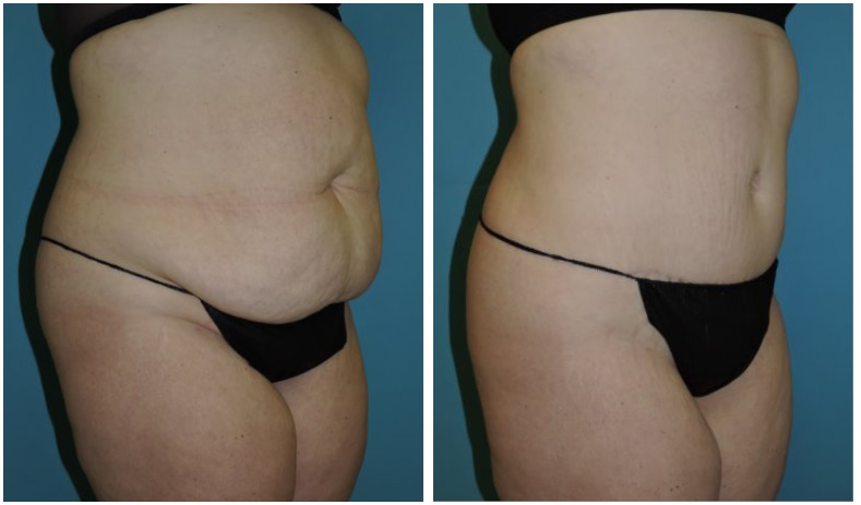 Abdominoplasty Before & After