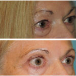 Thumbnail of http://Blepharoplasty%20Before%20&%20After