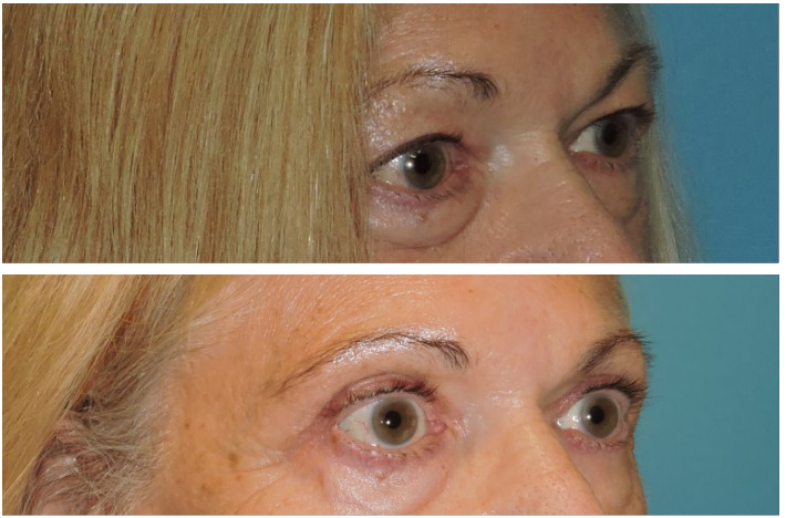 Blepharoplasty Before & After