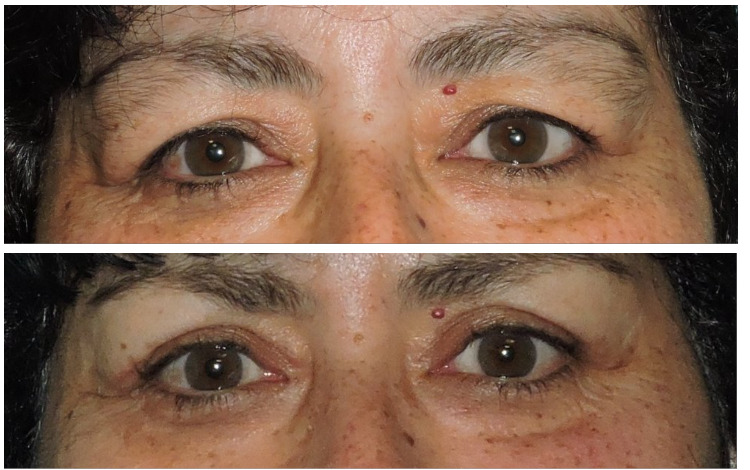 Blepharoplasty Before & After