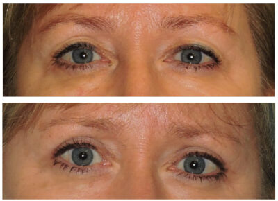 Blepharoplasty – Dr. Snyder Patient 14